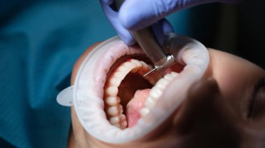 Diş hekimi, diş kliniğinde dişlerini matkapla tedavi ediyor. Taşıyıcı modern yöntemlerin teşhisi ve tedavisi