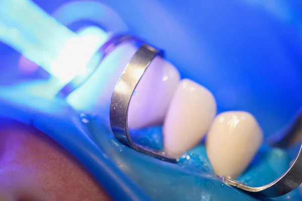 Light falling on teeth during installation of veneers in dental clinic closeup. Dentistry and dental treatment concept