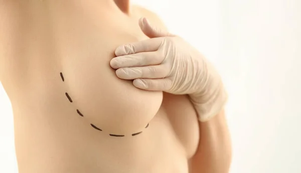 Krásná Žena Zakrývající Prsa Černými Chirurgickými Liniemi Plastická Chirurgie Zvětšení — Stock fotografie