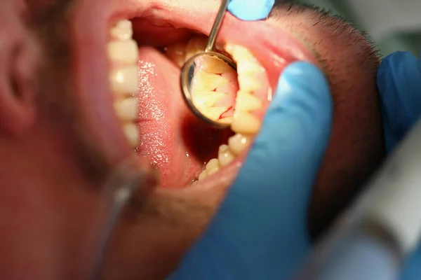 Dokter Gigi Memeriksa Gigi Laki Laki Dan Meradang Gusi Dengan — Stok Foto