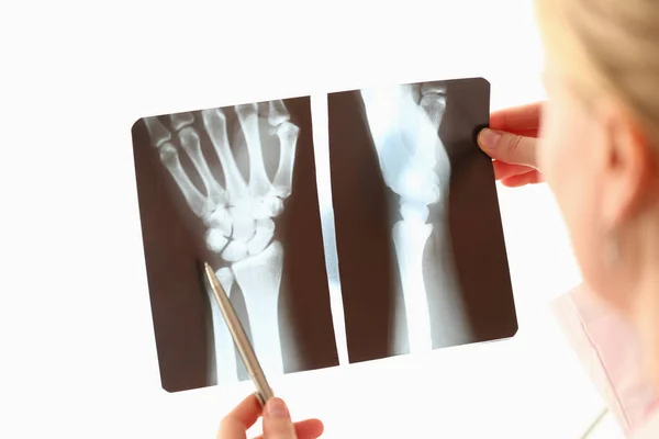 医生看了看手部X光片 病因及治疗概念 — 图库照片