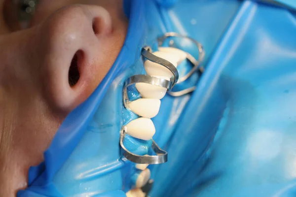 Pasien Kantor Dokter Gigi Untuk Memasang Gigi Palsu Atau Veneers — Stok Foto