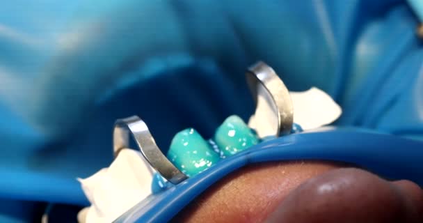 Zubař Aplikuje Modrý Gel Zub Před Instalací Dýh Detailní Kvalitní — Stock video