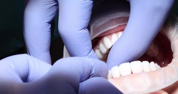 Installera Vit Faner Kvinnliga Tänder Inom Tandvården Proteser Och Ortodontisk — Stockvideo