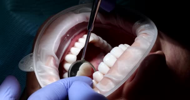 ゴム手袋の歯科医は鏡を反射して歯の裏側を見る 専門家は 診療所における患者の空洞の定期的な検査を行います — ストック動画
