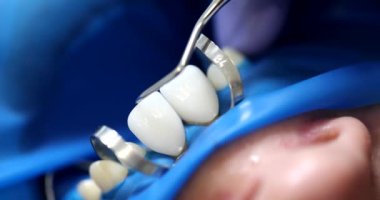 Diş hekimi sivri diş teçhizatı kullanarak beyaz seramik kaplamaları hastanın dişlerinden çıkarıyor. Klinikte yavaş çekimde insan boşluğuna profesyonel bakım
