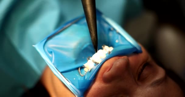 Стоматолог Обробляє Зуби Пацієнта Повітряним Потоком Щоб Позбутися Слини Фахівець — стокове відео
