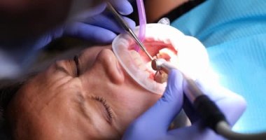 Dişçi, dişçi matkabı ve açılı aynayla çalışıyor. Diş hekimliği ve diş tedavisi kariyer kaldırma veya kaplama kurulumu