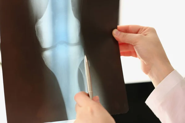 Γυναίκα Γιατρός Εξετάζει Ακτινογραφία Τραυματισμού Στο Γόνατο Στο Νοσοκομείο Ακολουθίες — Φωτογραφία Αρχείου