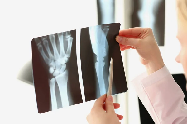 Femme Médecin Regarde Radiographie Une Blessure Bras Hôpital Séquelles Blessures — Photo