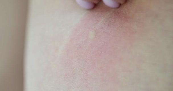 Gesundheitliche Probleme Weibliche Hand Juckt Pickel Juckender Allergischer Hautausschlag — Stockvideo