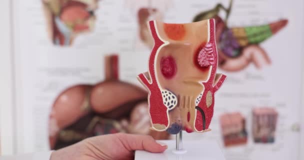 治疗直肠 痔疮和便秘等疾病 生理学家在解剖学模型中指出直肠病理学 — 图库视频影像