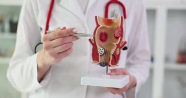Doktor yapay rektum modelini elinde tutuyor ve patolojiler kalemi sorunlara işaret ediyor. Laboratuvar önlüğü uzmanı rektal kanal ağır çekimde hastalıkları açıklıyor