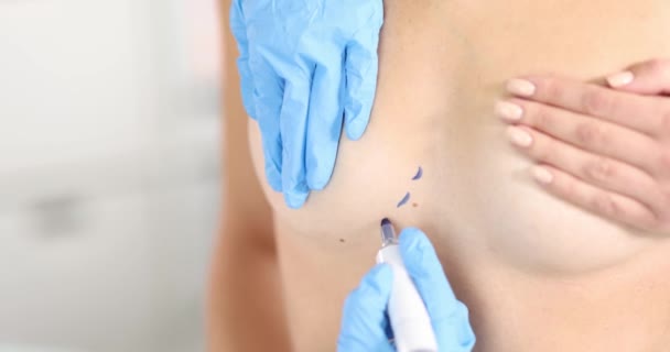 Médico Cirurgião Plástico Preparando Realizando Cirurgia Aumento Mama Com Implantes — Vídeo de Stock