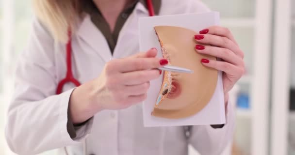Médico Ginecólogo Mostrando Modelo Anatómico Mama Femenina Con Enfermedades Primer — Vídeo de stock
