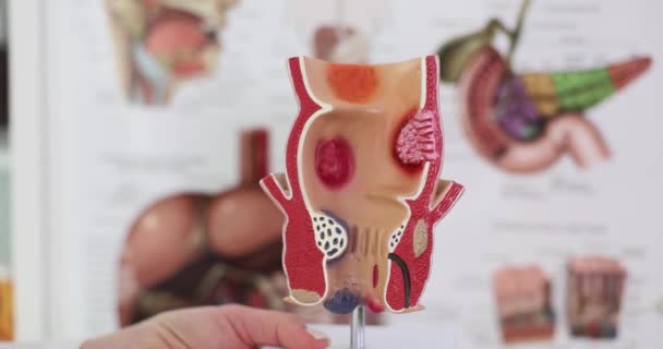 Anatomy Anus Treatment Diseases Rectum Hemorrhoids Proctologist Rectal Pathology Anatomical — Stock Video
