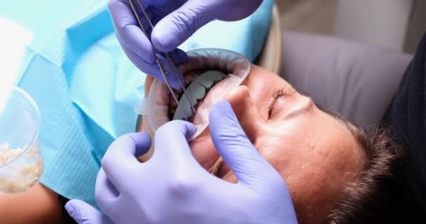 牙科医生对牙龈标本进行了测试 假牙和颌骨植入 — 图库视频影像