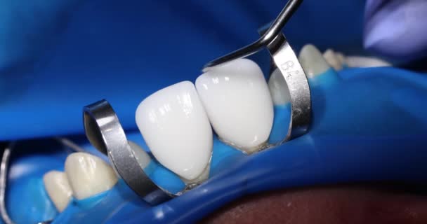 歯科医は プロの機器を使用して白いセラミックベンダーをインストールします 専門家は歯科クリニックで女性患者のための完璧な笑顔を作成します — ストック動画