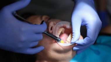 Diş hekimi klinikte kaplama ve protez için yapıştırıcı sürüyor. Dişçilik konseptinde anestezi
