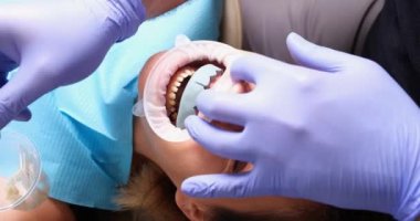 Lastik eldivenli dişçi klinikteki hastaların dişlerini profesyonel aletlerle tedavi ediyor. Uzman, kaplama kurulumu için boşluk hazırlıyor