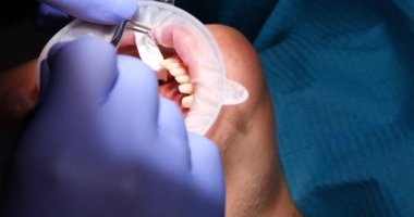 Yetenekli dişçi, kaplama takmadan önce dişlerini tedavi eder. Steril eldiven uzmanı klinikte diş tedavisi için diş çürüğü hazırlıyor