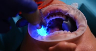 Profesyonel dişçi, kadın hastaların dişlerini yenilikçi aletlerle tedavi eder. Uzman, klinikte dişçi muayenesi yapıyor.