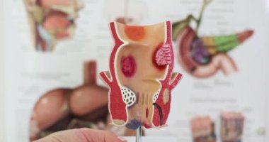 Klinikte hemoroitli rektumun anatomik modeli. Kronik hemoroid semptomlara ve tedaviye neden olur.
