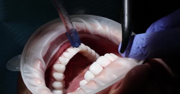 Dentista Profissional Luvas Borracha Lava Cavidade Oral Paciente Após Instalação — Vídeo de Stock