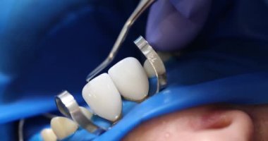Diş hekimi, diş kliniğindeki ağız boşluğuna seramik kaplama takıyor. Taç kusurlarının düzeltilmesi. Sabit protezler kullanılarak dişlerin bir kısmı.