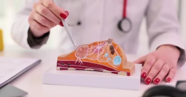 의사는 유방의 해부학적 모형을 사용하여 질병을 설명한다 질환에 — 비디오