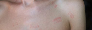 Red allergic spots rash on female body. Erythema causes symptoms of the disease