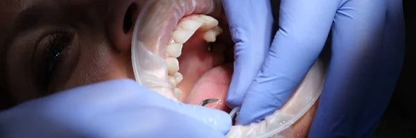 Dentist Prepares Female Teeth Installation Ceramic Veneers Crowns Removing Enamel — Stockfoto