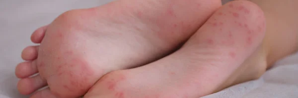 湿疹は 子供の足の皮膚のアレルギー性病変によって引き起こされる刺激です 小児の感染性皮膚疾患 — ストック写真
