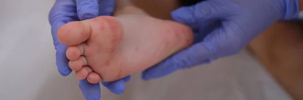 Висип Ентеровірусною Інфекцією Сімейства Піконейрових Ногах Дитини Медикаментозна Алергія Коронавірус — стокове фото