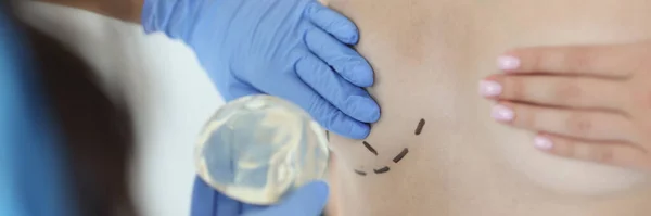 Surgeon Holds Silicone Implant Breast Augmentation Restoration Breast Women Partial — Stok fotoğraf