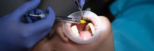 Οδοντίατρος Εγχέει Αναισθητικό Τσίχλα Ασθενούς Για Ανώδυνη Οδοντιατρική Θεραπεία Closeup — Φωτογραφία Αρχείου
