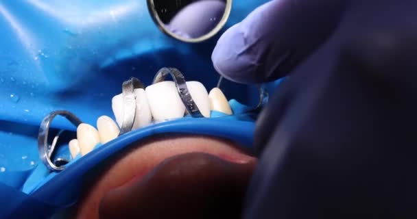 Dentista Instala Carillas Los Dientes Del Paciente Utilizando Herramientas Metálicas — Vídeos de Stock