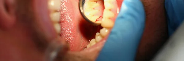 Zubař Zkoumá Mužské Zuby Zanícené Dásně Zrcadlem Zkoumání Problematického Pojetí — Stock fotografie