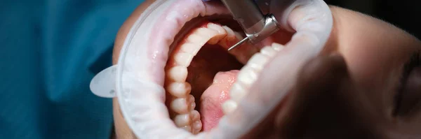 Dentist Treating Patient Teeth Drill Dental Clinic Closeup Diagnosis Treatment — Stock Photo, Image