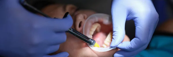 Dentist Doctor Applying Adhesive Veneers Prosthetics Clinic Closeup Anesthesia Dentistry — Stock Photo, Image