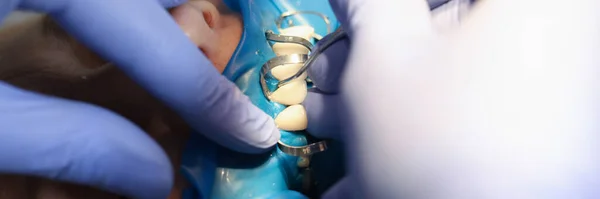 Zahnarzt Fixiert Furnier Auf Patientenzähnen Mit Metallwerkzeugen Nahaufnahme Prothetik Zahnmedizinischen — Stockfoto
