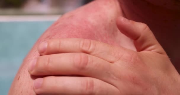 Mann Kratzt Geröteten Hautausschlag Mit Seiner Hand Nahaufnahme Film Sonnenallergiekonzept — Stockvideo