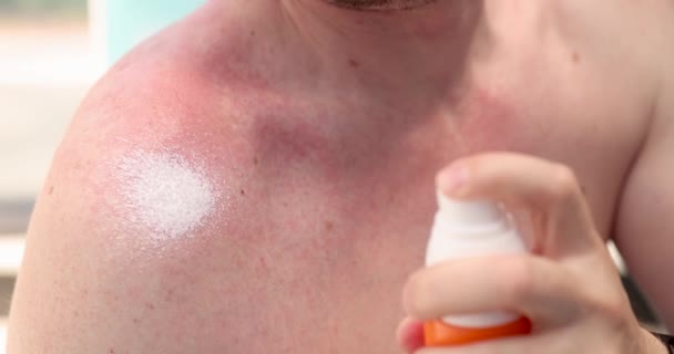 赤い刺激の肌に保湿クリームを適用男は4Kムービーを閉じます アレルギー性じんましん治療の概念 — ストック動画