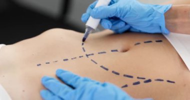 Doktor estetik cerrah hasta karnının 4K filminin derisine ameliyat öncesi işaretler çiziyor. Estetik cerrahi ve estetik tıp yağ aldırma konsepti