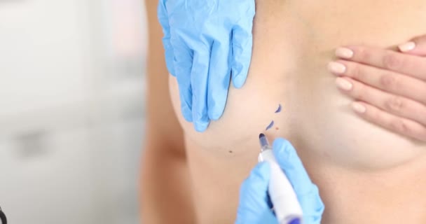 Cirurgião Plástico Desenhando Marcações Pré Operatórias Peito Paciente Filme Conceito — Vídeo de Stock