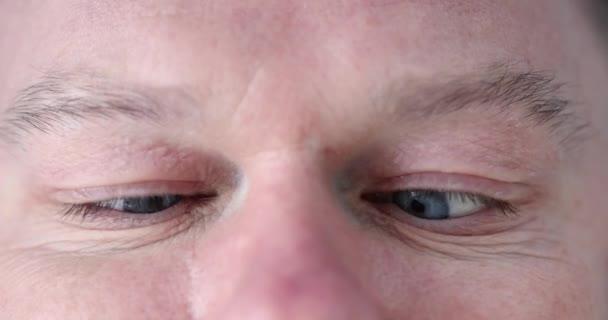 Primer Plano Los Ojos Masculinos Con Estrabismo Convergente Película Tratamiento — Vídeos de Stock