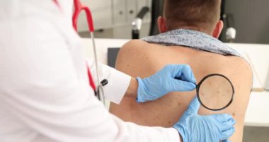 Dermatolog, klinikteki doğum lekesini büyüteçle inceliyor. Edinilen melanositik nevus kavramı