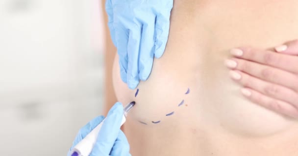 Plast Kirurg Ritning Linje Bröst Patient Med Markör Närbild Film — Stockvideo