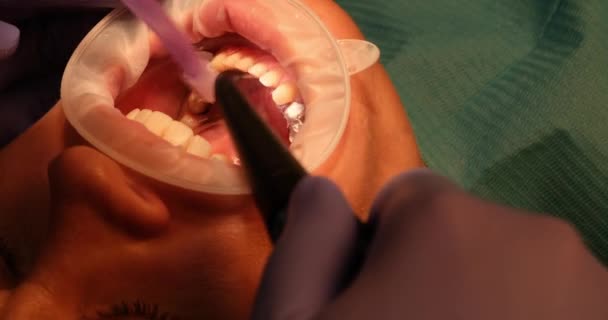 Dentist Cleans Dirt Patient Teeth Water Spray Clinic Doctor Does — Stok video