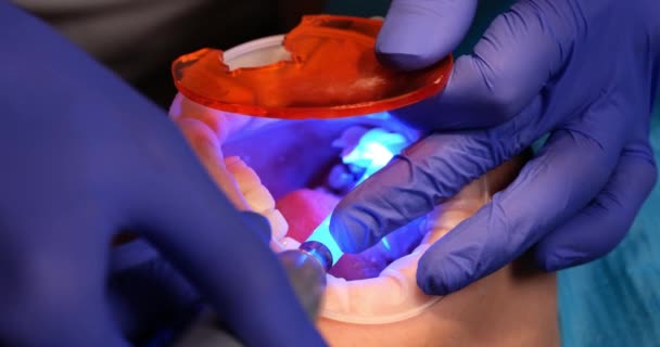 Dentist dries photopolymer filling in patient tooth with UV lamp in clinic. Doctor treats caries in customer oral cavity in hospital office
